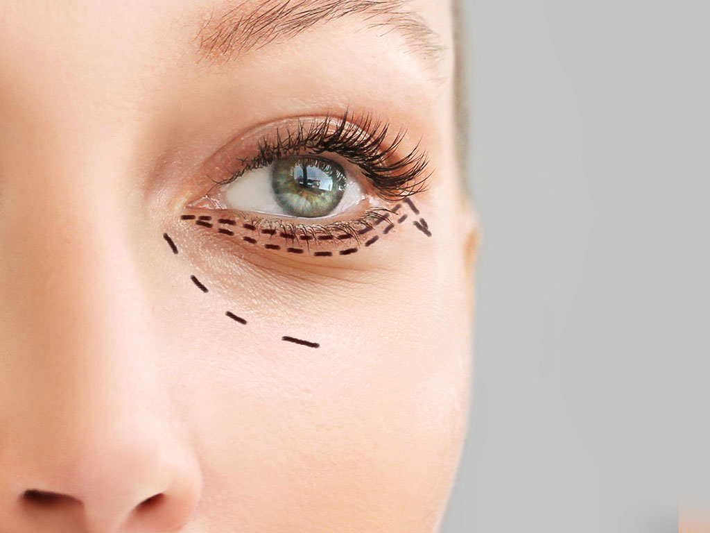blefaroplastia