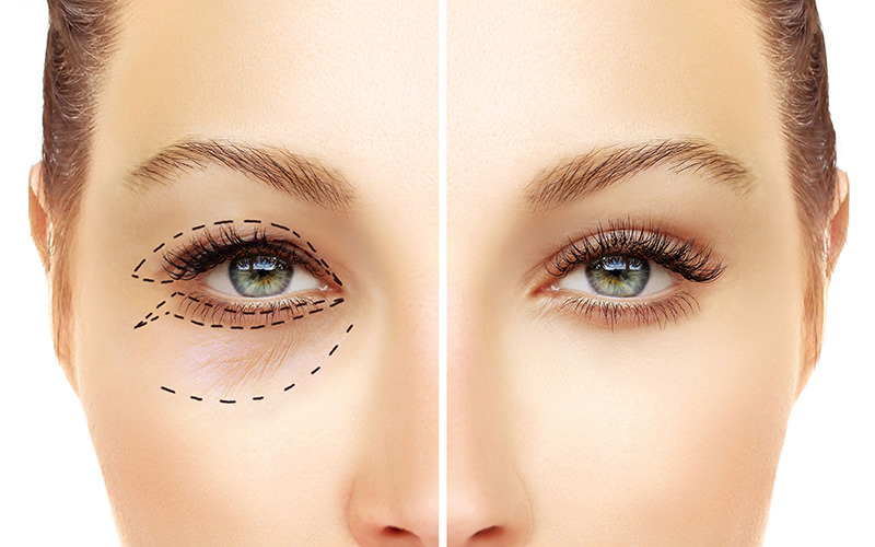 blefaroplastia