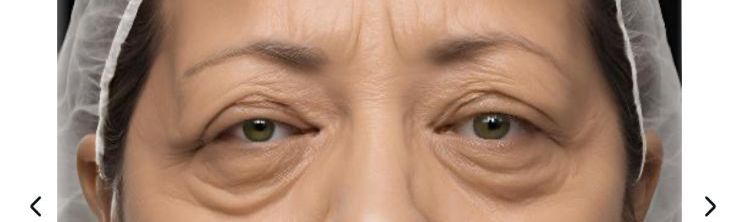 Idade Blefaroplastia