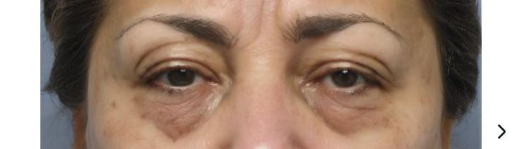 Dra. Lara El Andere especialista em olhar cansado e blefaroplastia São Paulo