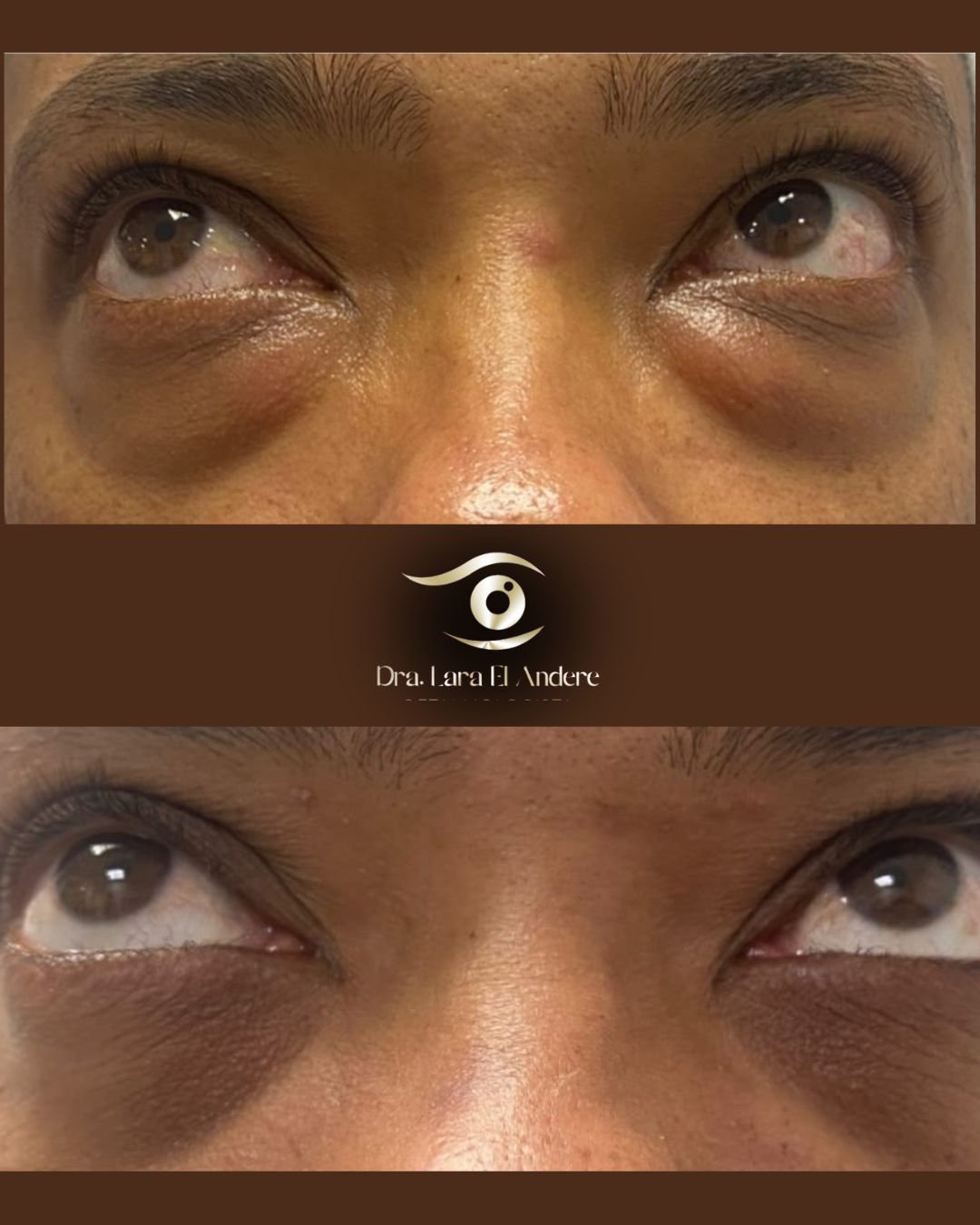 Blefaroplastia transconjuntival