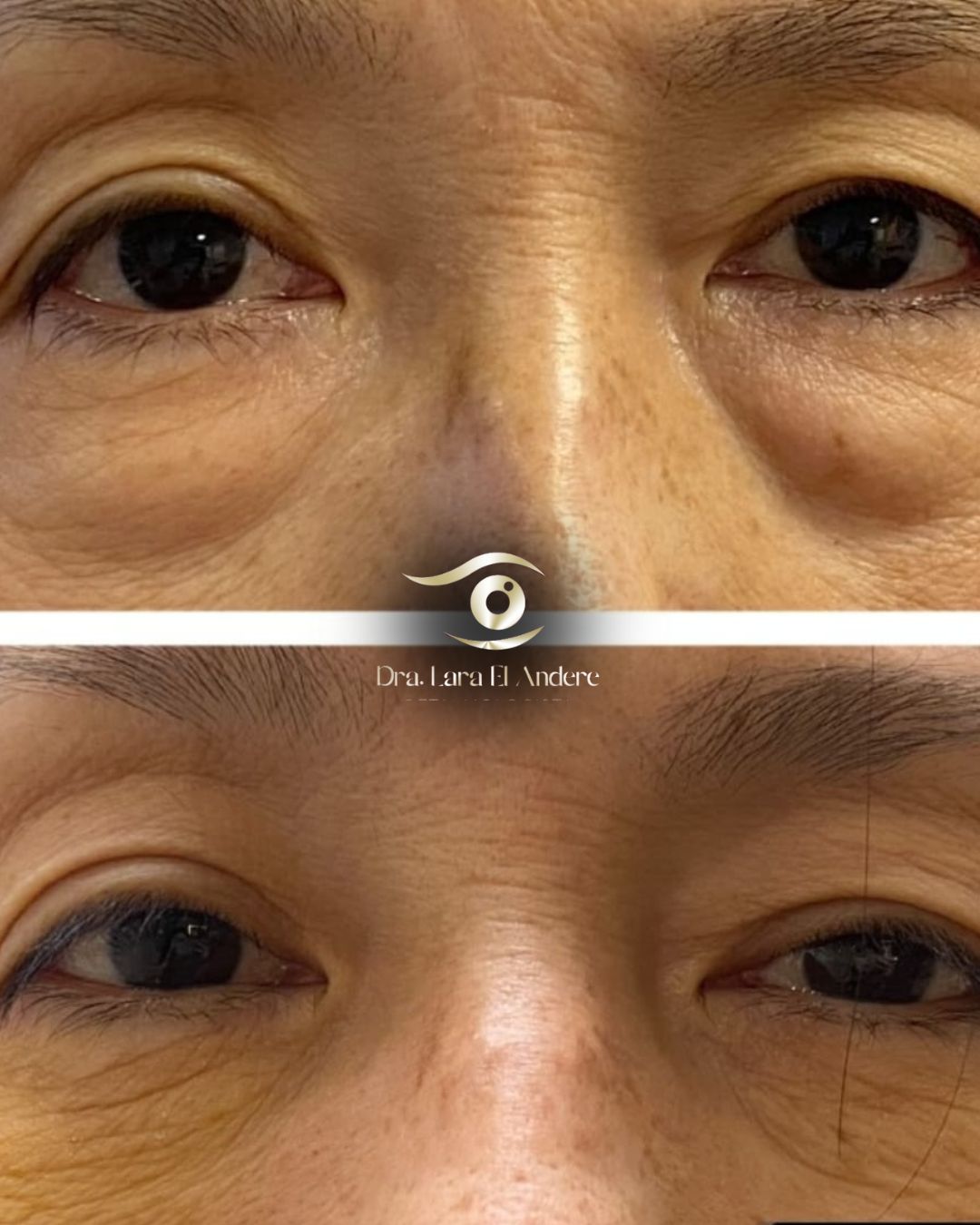 Dra. Lara El Andere especialista em blefaroplastia em orientais São Paulo