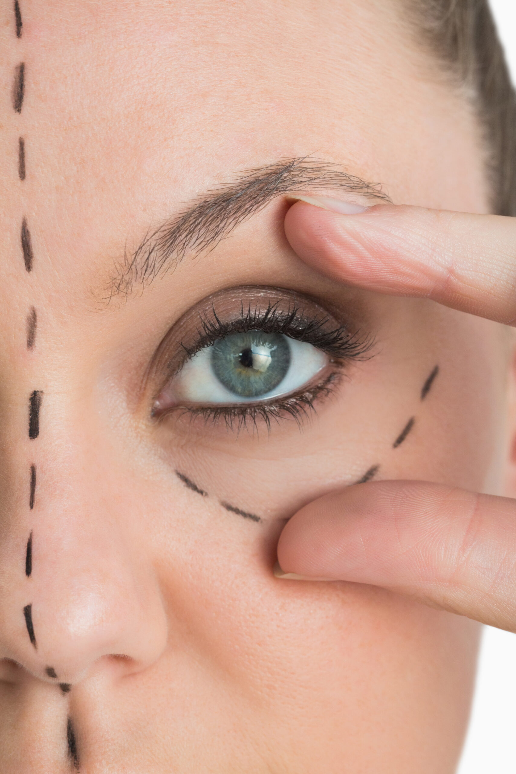 blefaroplastia