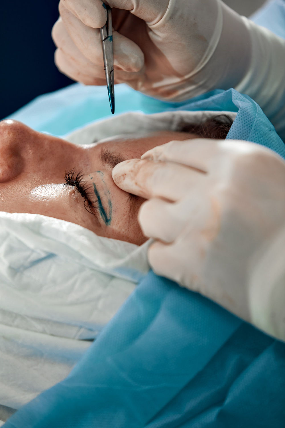 Blefaroplastia Cicatriz