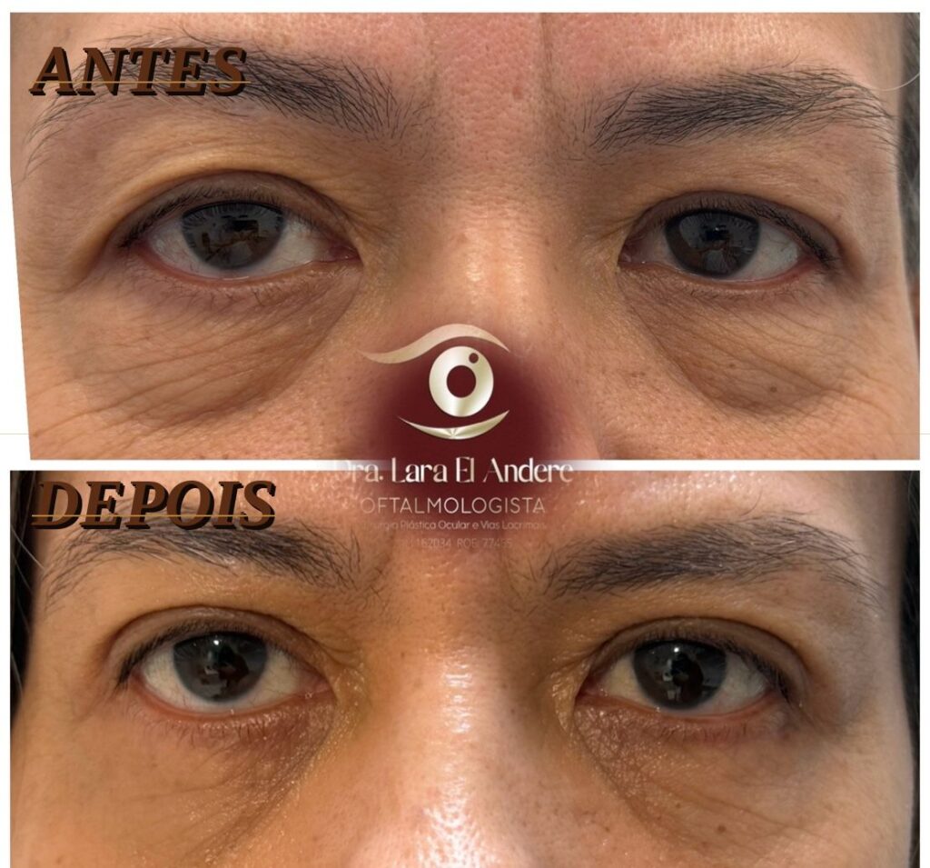 Blefaroplastia