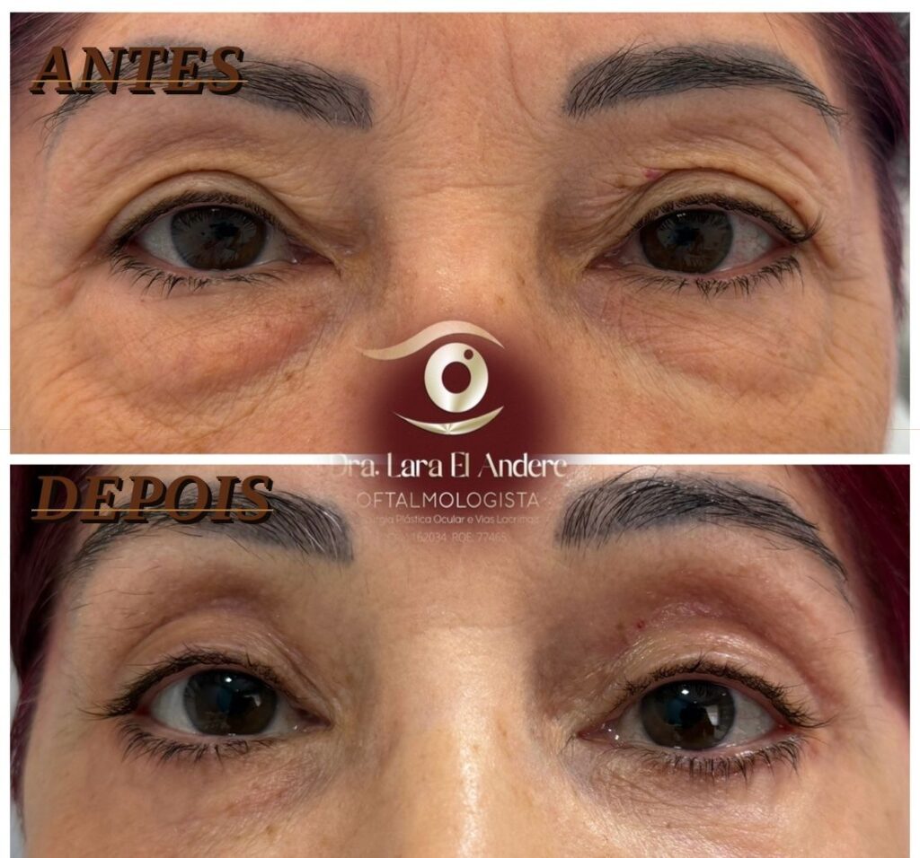 Blefaroplastia