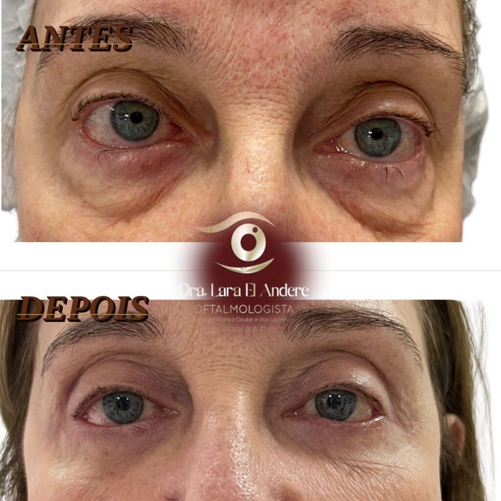 blefaroplastia antes e depois resultado natural Dra. Lara El Andere