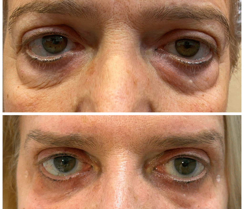 blefaroplastia