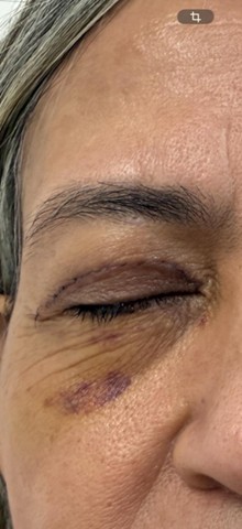 Blefaroplastia com pontos