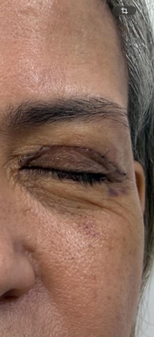 Blefaroplastia com pontos