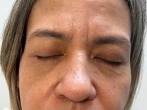 blefaroplastia