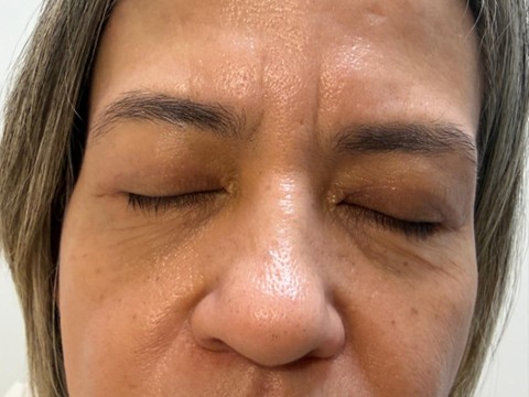 blefaroplastia