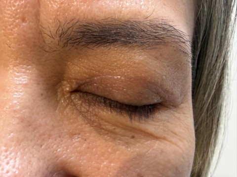 blefaroplastia