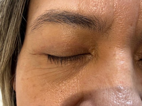 blefaroplastia