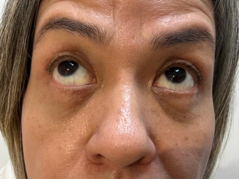 blefaroplastia