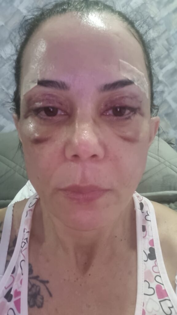 Blefaroplastia