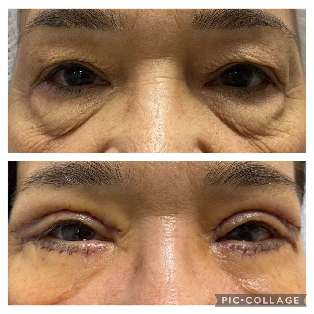 blefaroplastia