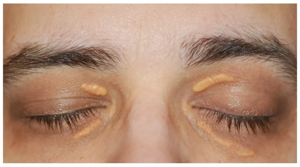 xantelasma